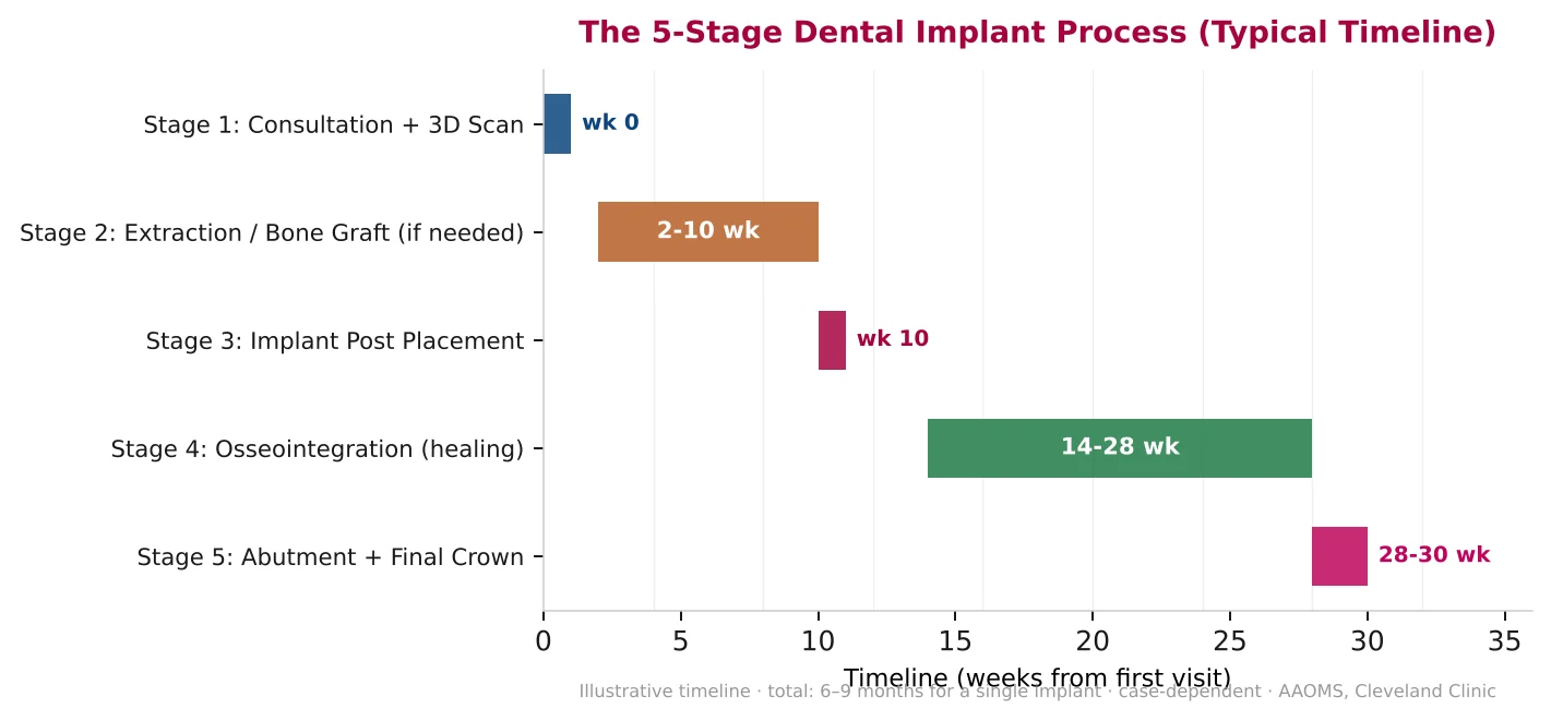 Timeline chart of the 5-stage dental implant process — consultation and 3D scan at week 0, extraction or bone graft weeks 2 to 10, implant post placement at week 10, osseointegration weeks 14 to 28, and abutment with final crown weeks 28 to 30.