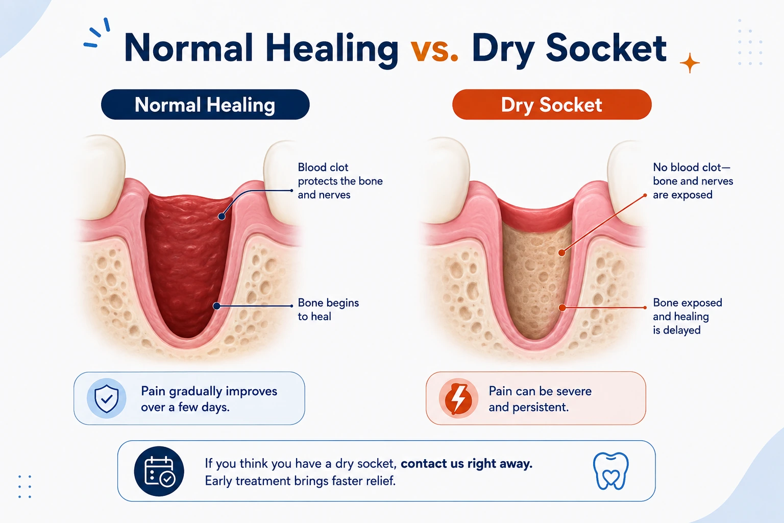 Cross-section comparison of normal healing versus dry socket — in normal healing a blood clot protects the bone and nerves and pain gradually improves, while in dry socket no clot is present, bone and nerves are exposed, healing is delayed and pain can be severe and persistent.