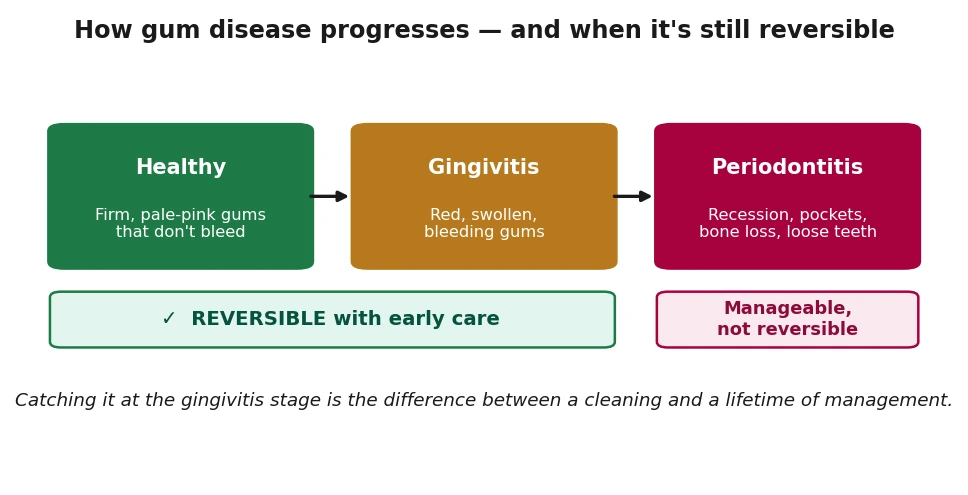 Diagram showing gum disease progressing from healthy gums to gingivitis to periodontitis, with gingivitis marked reversible with early care and periodontitis marked manageable but not reversible.