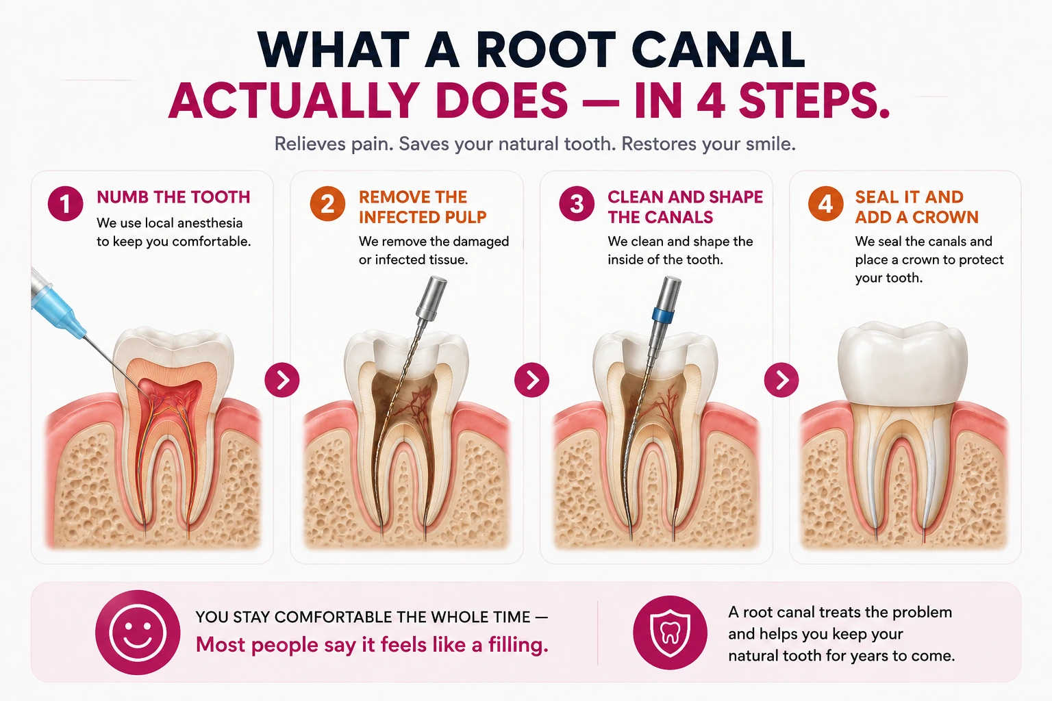 Four steps of a root canal — numb the tooth with local anesthesia, remove the infected pulp, clean and shape the canals, then seal it and add a crown, with a note that most people say it feels like a filling.